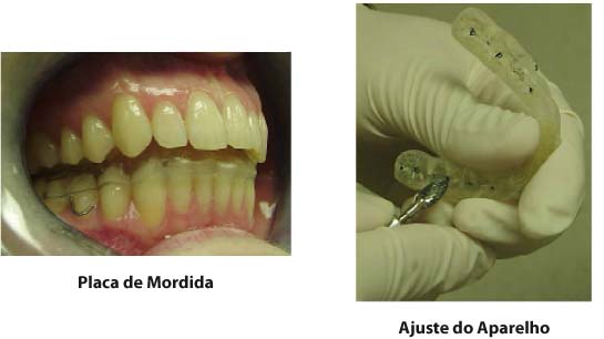 Aparelho Intraoral