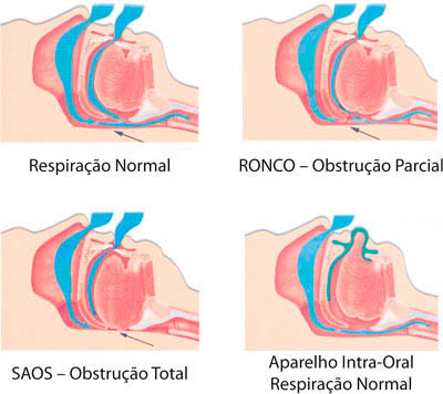 SAOS-Respiração Normal