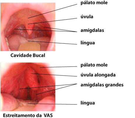 Apneia do Sono